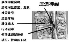 腰间盘突出最新疗法，革新带来希望，自信引领未来康复之路